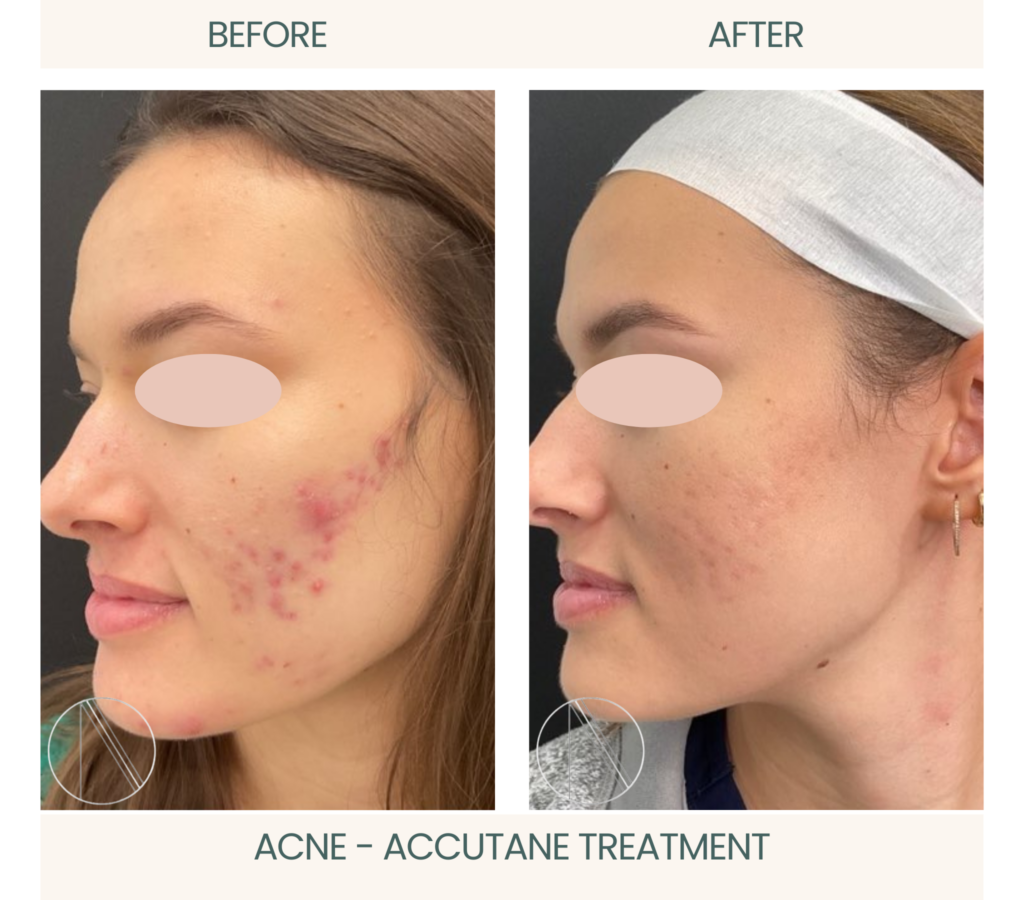 Ayana Dermatology & Aesthetics: Acne's significant before-and-after transformation through effective Accutane treatment for clearer, radiant skin.