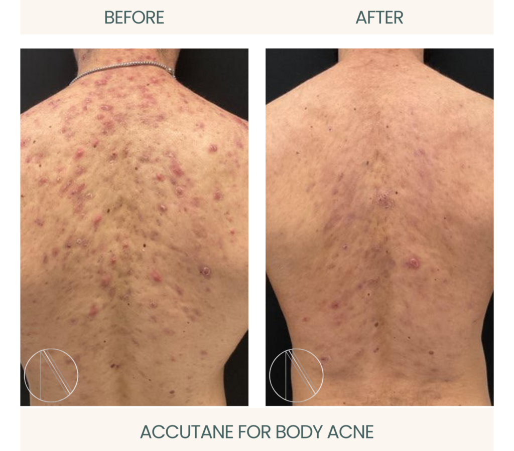Visible results with Accutane for Body Acne treatment, illustrating effective skincare transformation for clearer skin