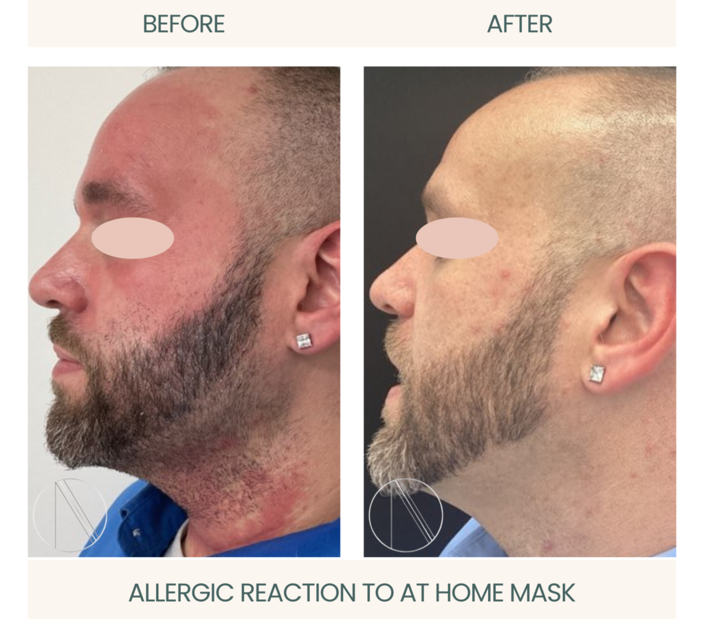 Recovery progress after Allergic Reaction to At-Home Mask Treatment, showcasing improved skin health and care