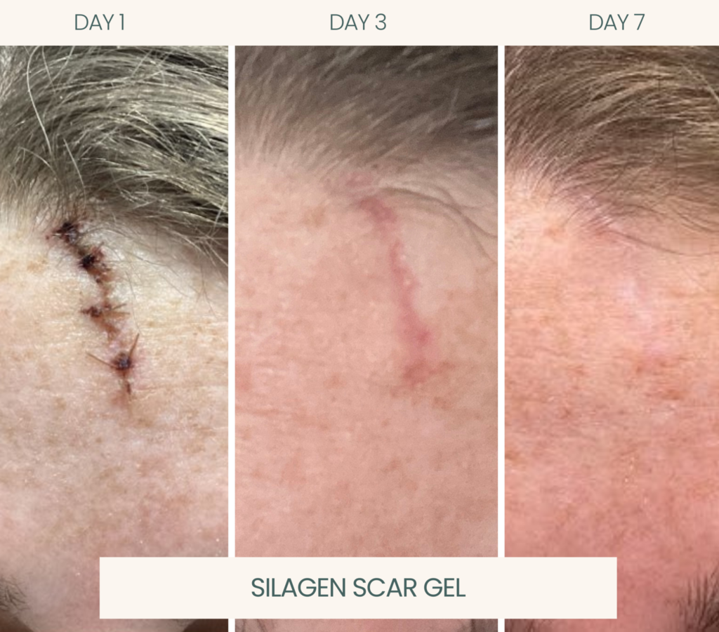 Silagen Scar Gel featured at Ayana Dermatology & Aesthetics, promoting effective skincare solutions for scar management