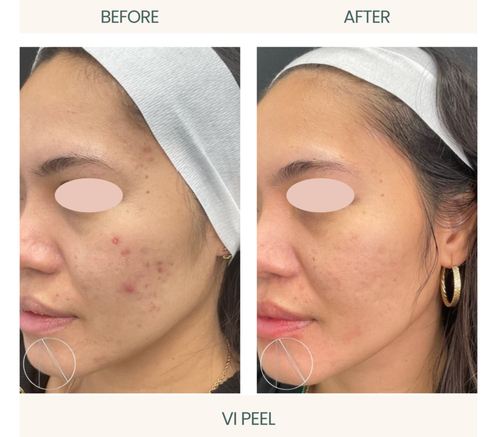 Ayana Dermatology & Aesthetics features the transformative VI Peel, revealing radiant, renewed skin in a single treatment."