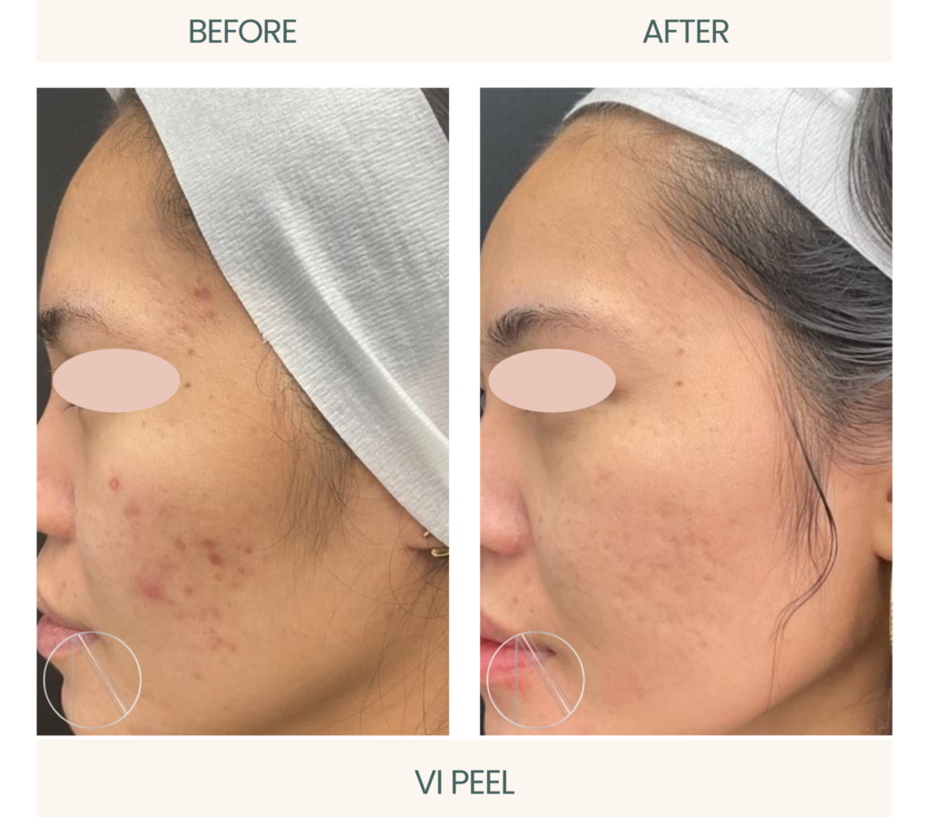 Ayana Dermatology & Aesthetics showcases skin renewal with VI Peel, unveiling a radiant and refreshed complexion.