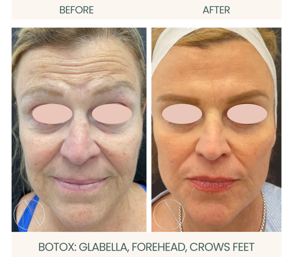Smooth, youthful skin: Ayana Dermatology & Aesthetics delivers Botox precision for glabella, forehead, and crow's feet rejuvenation.
