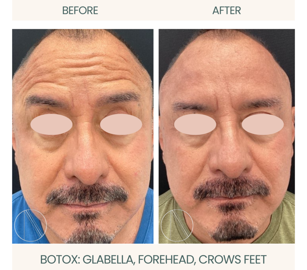 Ayana Dermatology & Aesthetics: Experience wrinkle-free beauty with Botox targeting glabella, forehead, and crow's feet areas.