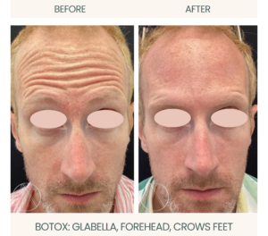 Ayana Dermatology & Aesthetics achieves smoother skin with precise Botox treatment on glabella, forehead, and crow's feet.