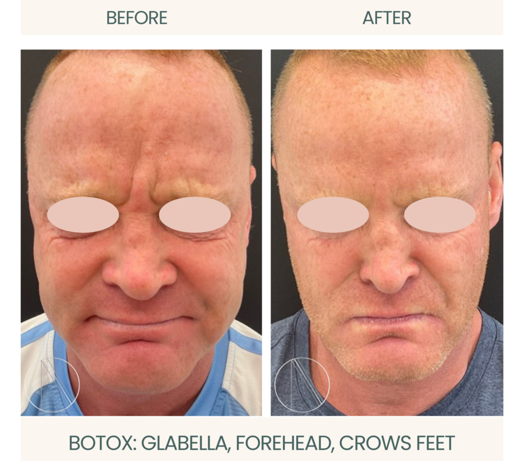 Ayana Dermatology & Aesthetics showcases precise Botox treatment targeting glabella, forehead, and crow's feet for smoother skin.