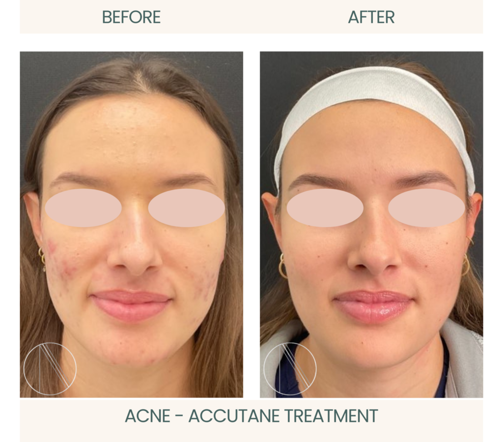 Ayana Dermatology & Aesthetics showcases Acne transformation with impressive before-and-after results using effective Accutane treatment.
