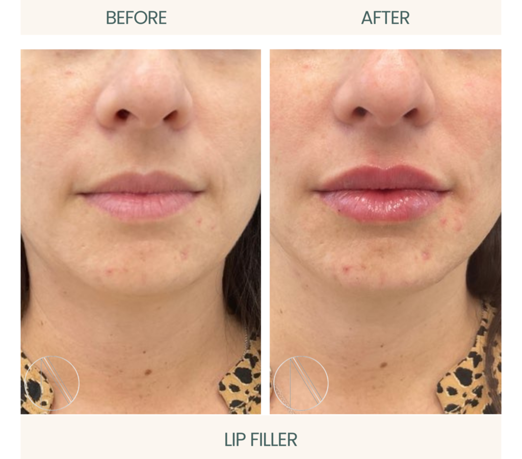 Ayana Dermatology & Aesthetics enhances lips with expertly administered filler for natural, plump, and youthful results.