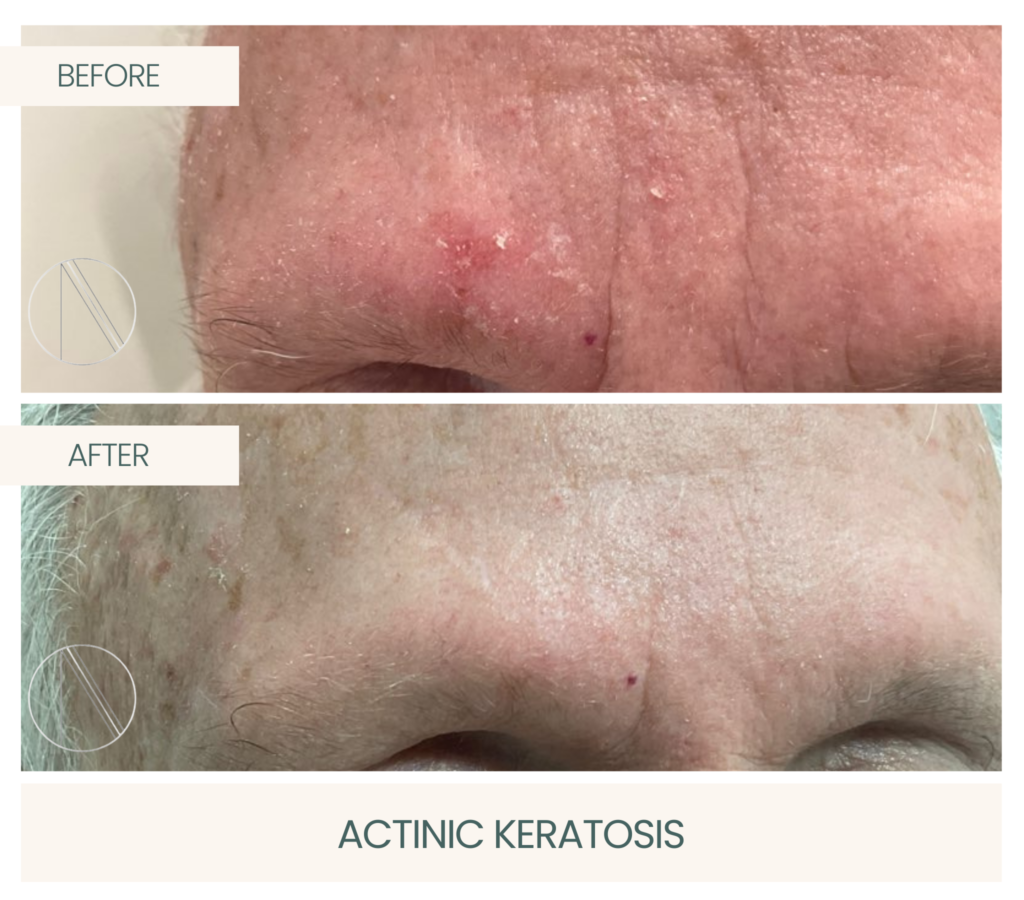 Ayana Dermatology & Aesthetics addresses Actinic Keratosis, providing effective treatment for healthier, rejuvenated skin appearance.