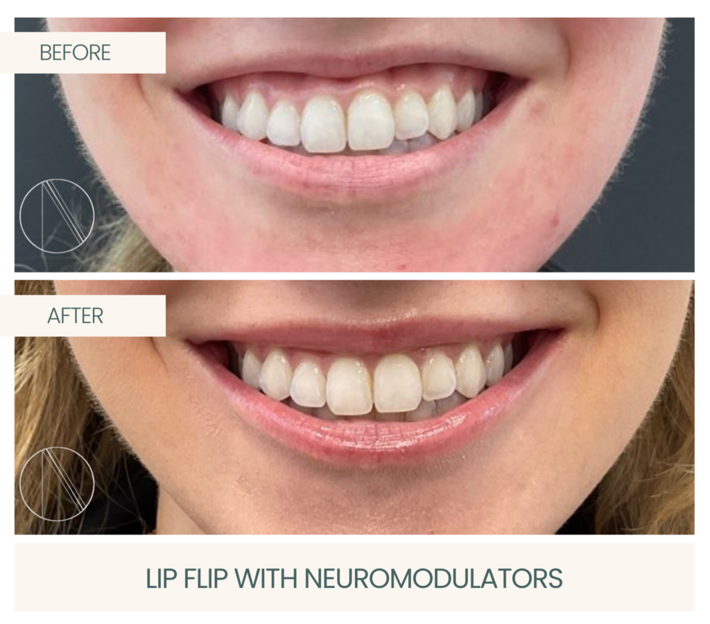 Experience Ayana Dermatology & Aesthetics' Lip Flip magic, utilizing neuromodulators for a subtly enhanced and youthful smile.