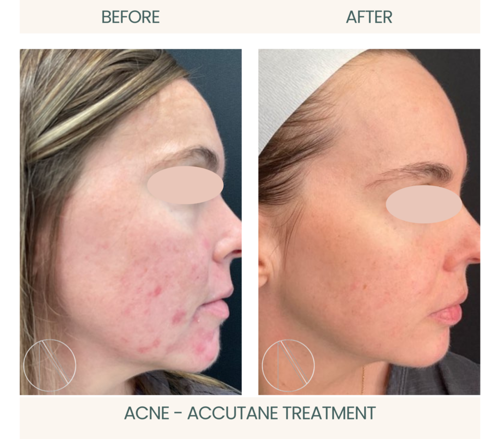 Ayana Dermatology & Aesthetics unveils Acne's before-and-after transformation with effective Accutane treatment for clear, radiant skin.