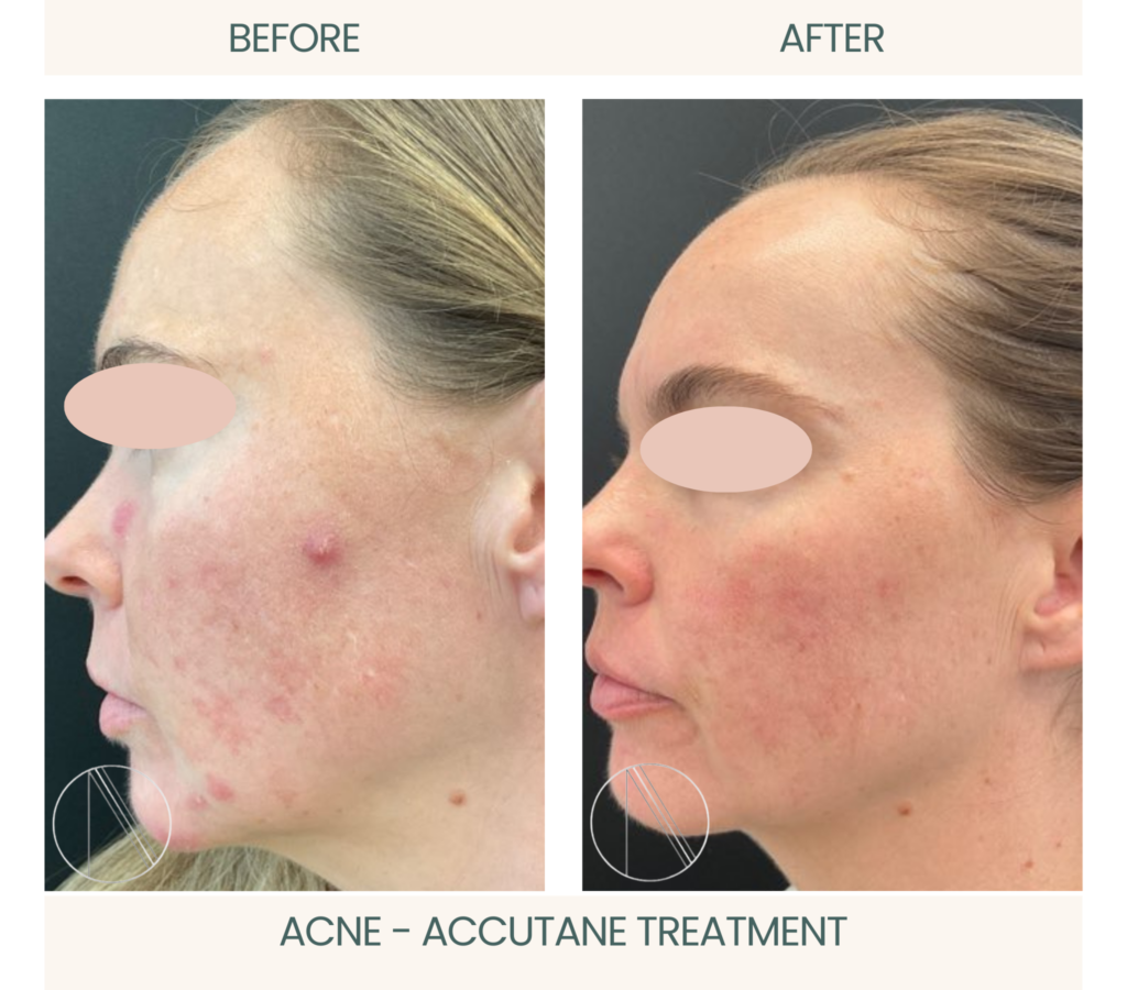 Ayana Dermatology & Aesthetics: Witness the remarkable transformation with before-and-after images of Acne treated with Accutane.
