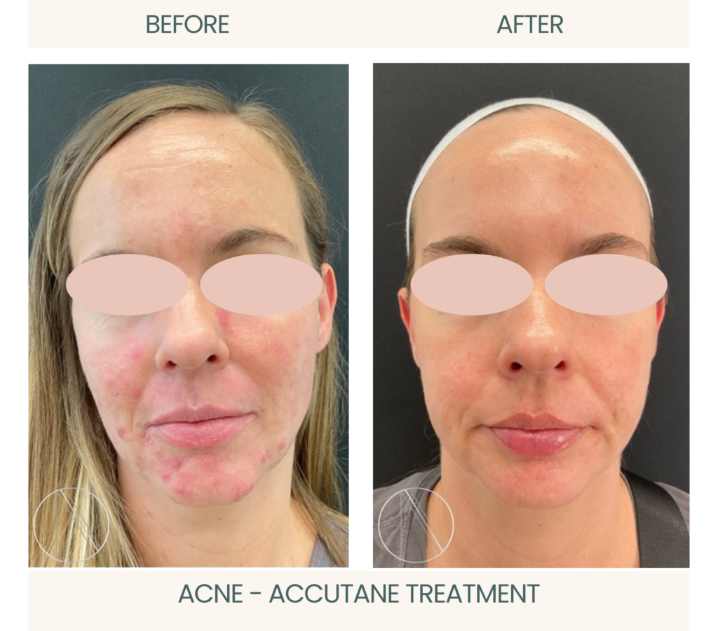 Ayana Dermatology & Aesthetics achieves clear skin through powerful Accutane treatment, showcasing successful acne resolution.