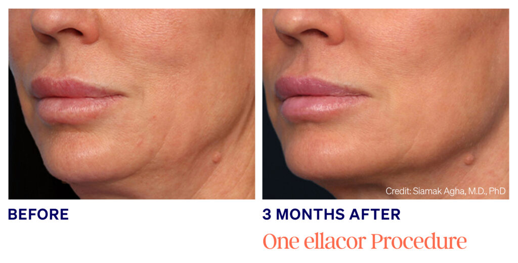 Agha-Female 3 months after ellacore, ellacor before and after face