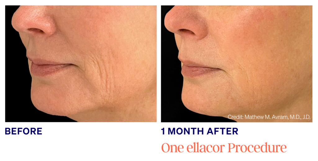 Ayana Dermatology & Aesthetics reveals stunning results: 1 month post-Ellacor treatment, achieving radiant and flawless skin.