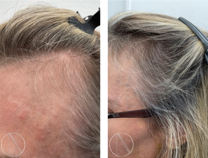 Read more about the article Best Hair Loss Treatments for Receding Hairline in Women