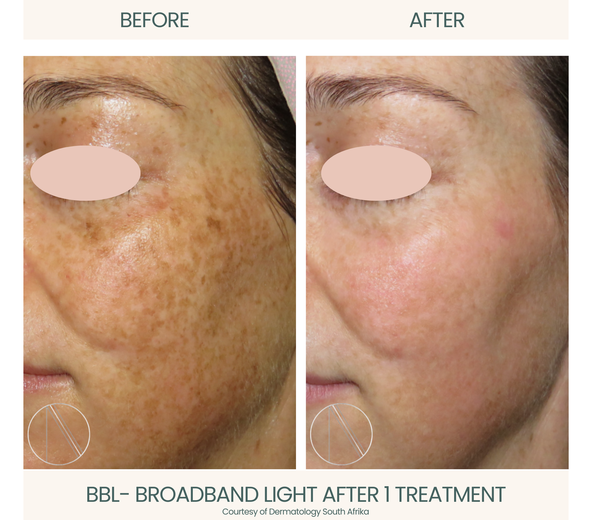 Ayana Dermatology & Aesthetics showcases transformative skin enhancement with BBL, addressing various concerns for radiant results.