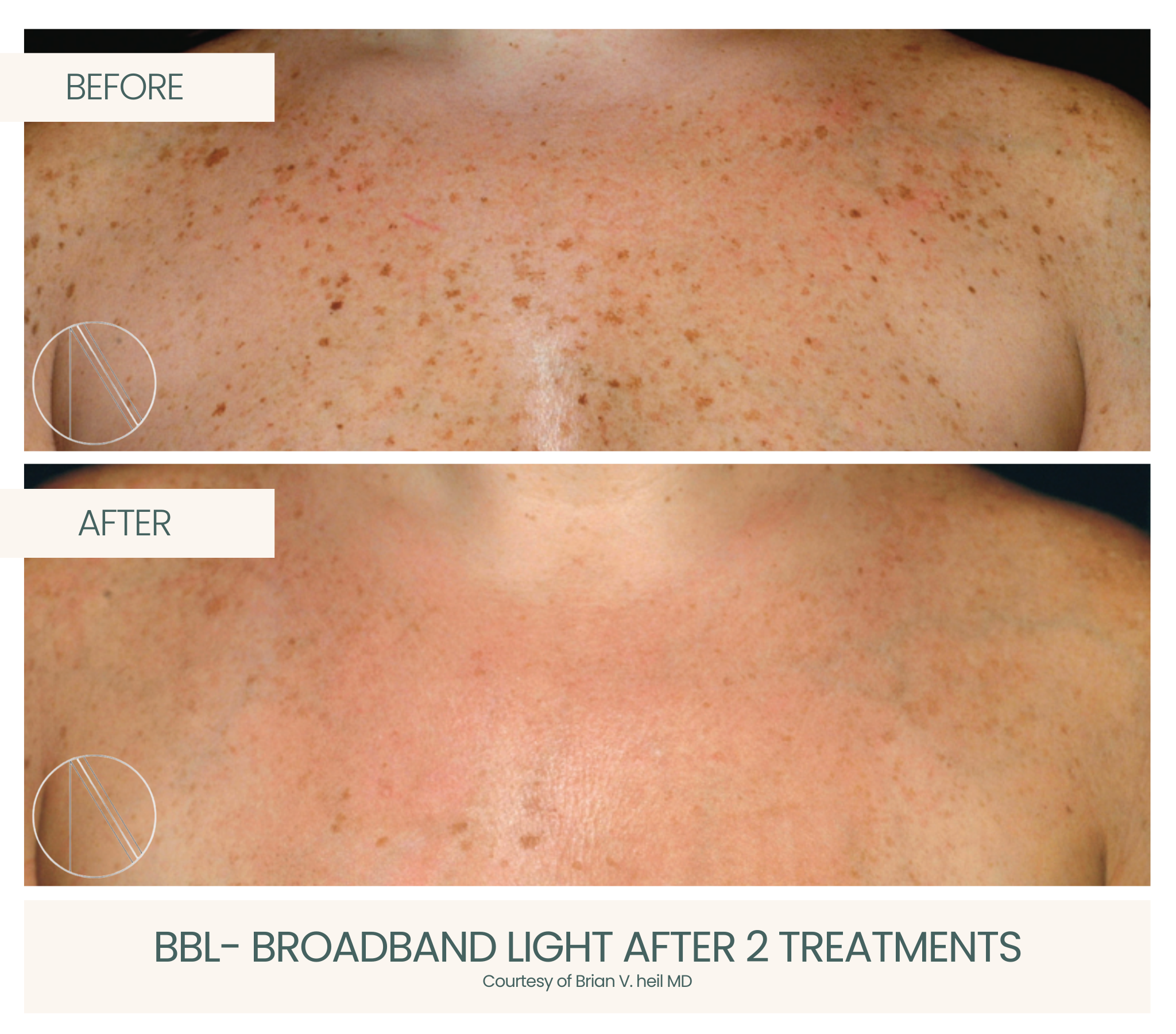 Ayana Dermatology & Aesthetics achieves radiant skin with BBL, a powerful broadband light treatment for rejuvenation.