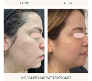 Ayana Dermatology & Aesthetics displays Microneedling with Exosomes, enhancing skin renewal for a vibrant, youthful appearance.