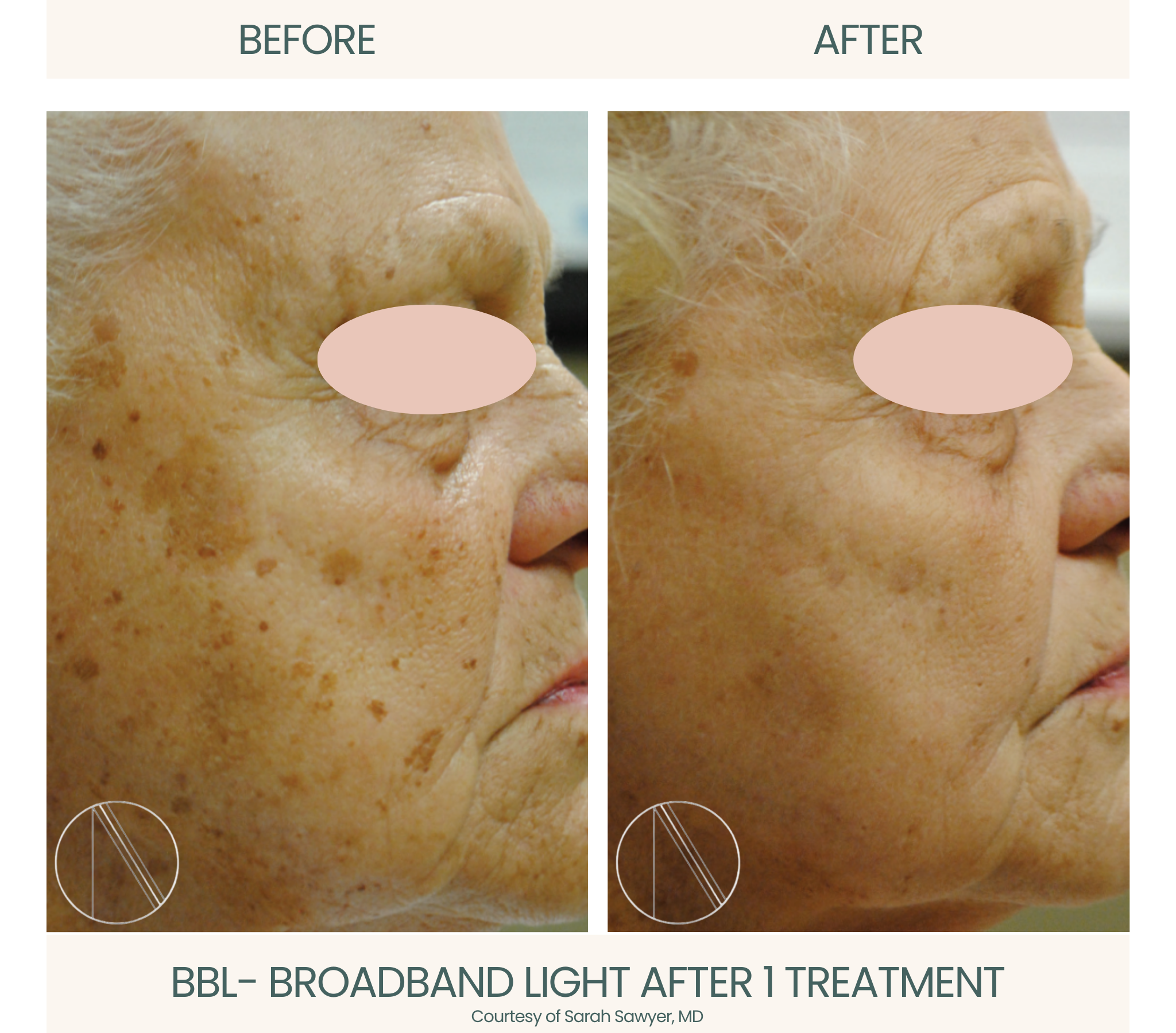 Ayana Dermatology & Aesthetics transforms skin with the rejuvenating power of BBL, achieving radiant and flawless complexion.