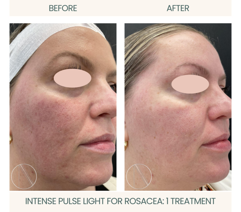 Effectiveness of Laser Treatment for Rosacea: Cause & Treatment
