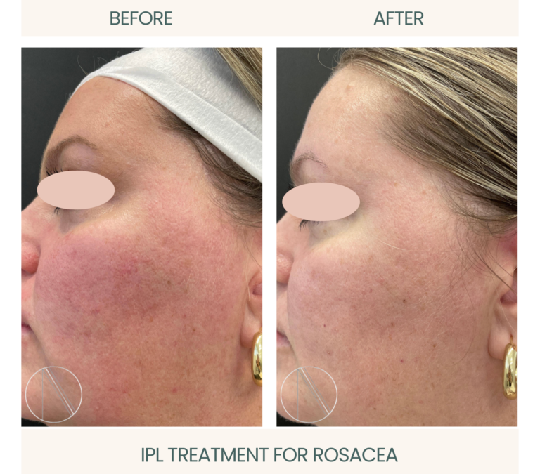 Effectiveness of Laser Treatment for Rosacea