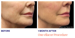 Ayana Dermatology & Aesthetics reveals the impact of one Ellacor procedure, achieving radiant, revitalized skin.