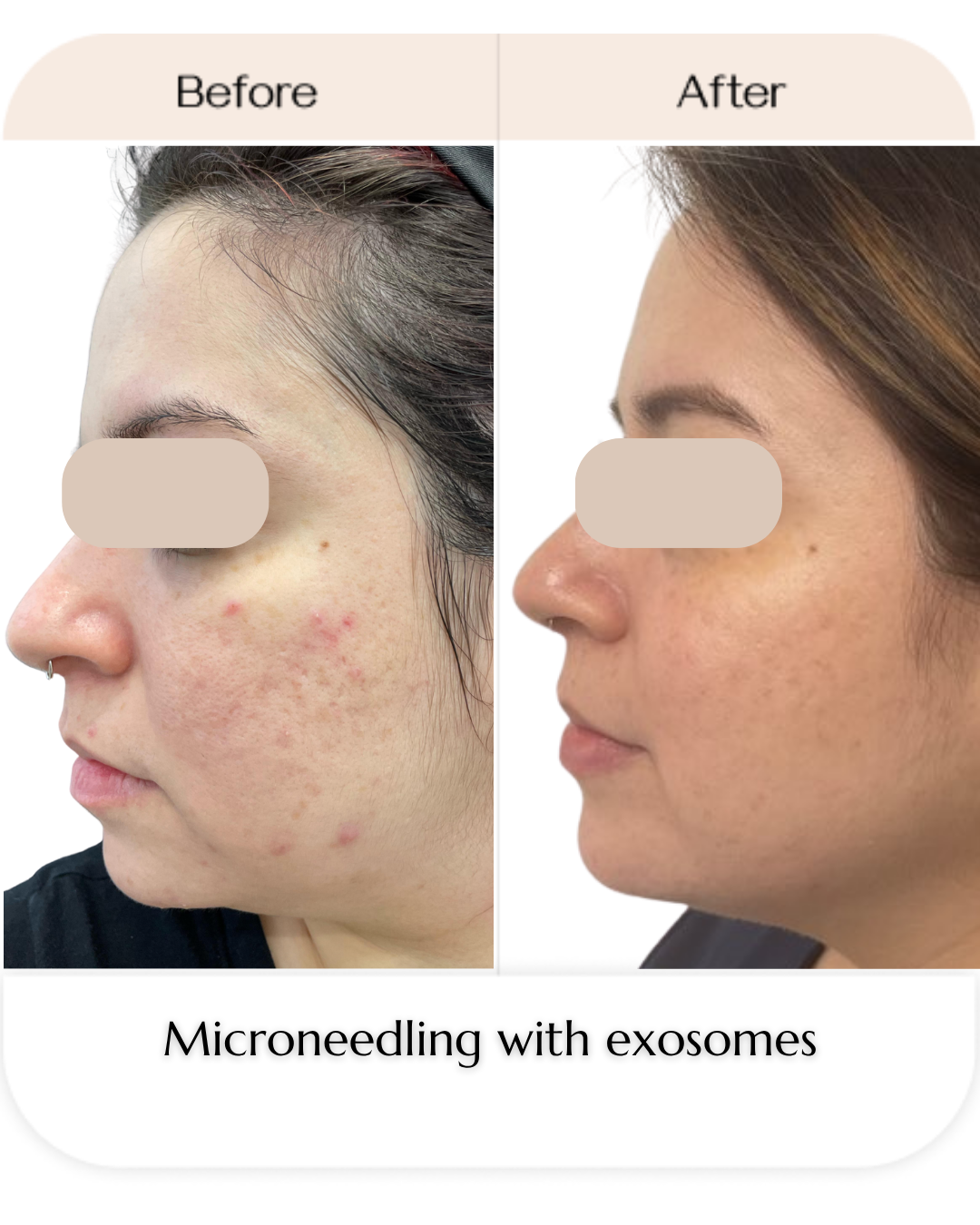 Ayana Dermatology & Aesthetics in fort lauderdale patient before and after microneedling treatment